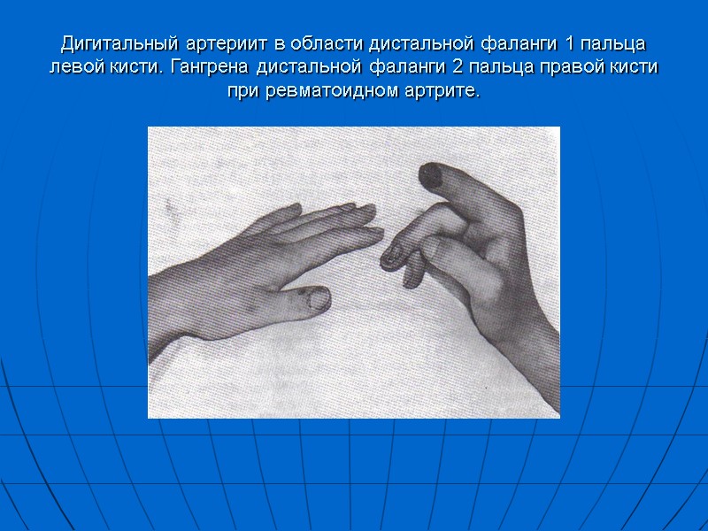 Дигитальный артериит в области дистальной фаланги 1 пальца левой кисти. Гангрена дистальной фаланги 2